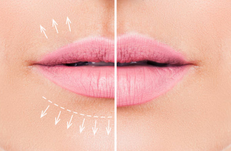 Lip Flip vs Lip Fillers